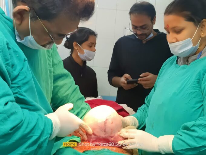 महिला के पेट से निकला 5किलो का ट्यूमर