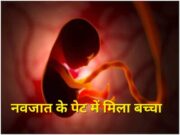 आश्चर्य : चार दिन पहले जन्मी बच्ची के पेट मे मिला बच्चा