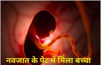 आश्चर्य : चार दिन पहले जन्मी बच्ची के पेट मे मिला बच्चा